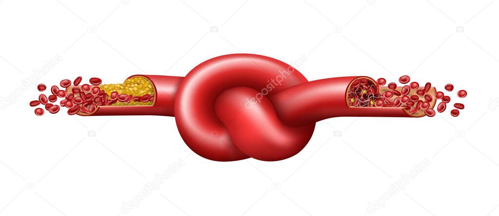 Vein with cholesterol and blood clot tied in a knot. Vector illustration