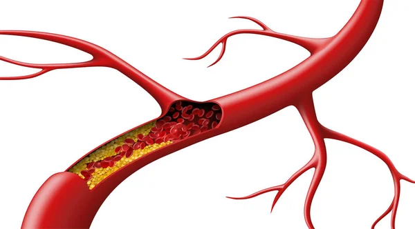 白い背景にコレステロールによってブロックされた動脈内の赤血球 ベクターイラスト — ストックベクタ