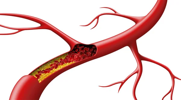 Červené Krvinky Tepně Blokované Cholesterolem Bílém Pozadí Vektorová Ilustrace — Stockový vektor