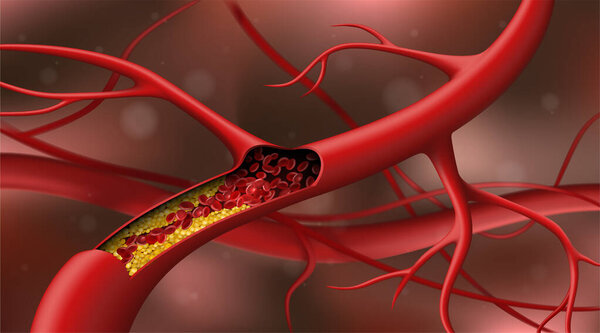 Artery blocked by cholesterol. Vector illustration