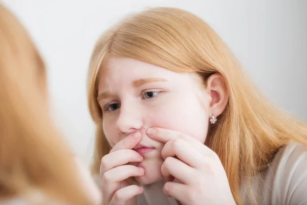 Menina Adolescente Examina Acne Rosto Frente Espelho — Fotografia de Stock