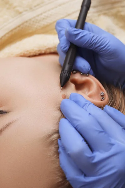 Electrocoagulation of vessels on the face — Stock Photo, Image