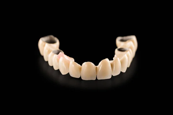 Dental ceramic bridge on isolated black background — Stock Photo, Image