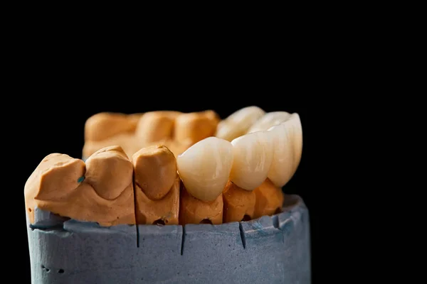 Белые Керамические Зубы Изолированы Черном Фоне — стоковое фото