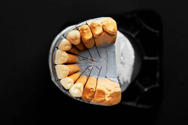 黒の背景に隔離された白いセラミック歯 — ストック写真
