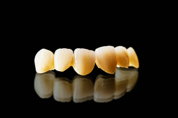 Denti Ceramica Bianca Isolati Sfondo Nero — Foto Stock