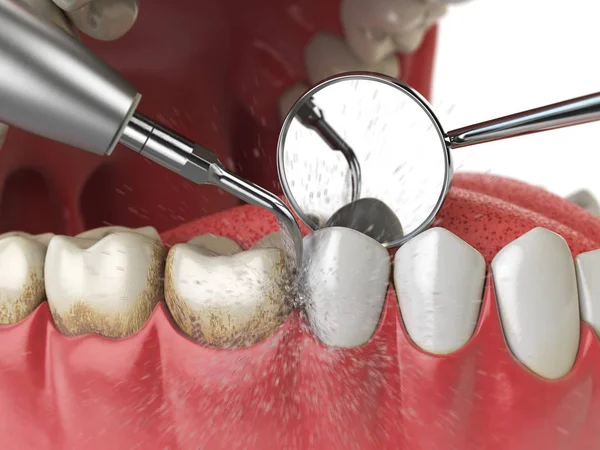 プロの歯のクリーニングします 洗浄機超音波歯は人間の歯から歯石を削除します イラストレーション — ストック写真