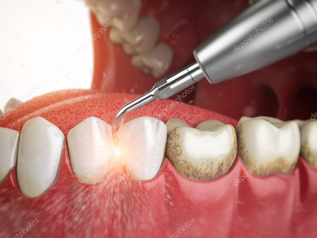 Professional teeth cleaning. Ultrasonic teeth cleaning machine delete dental calculus from human teeth. 3d illustration