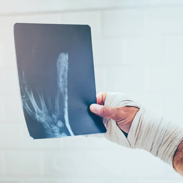 Patiënt Bestudeert Een Röntgenstraal Van Een Gebroken Hand Het Lumen — Stockfoto