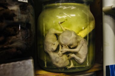 Formalin ile kavanozda patoloji deri altı kanaması olan insan ikizlerinin fetüsü