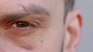Yakın çekim yakışıklı erkek göz kameraya bakıyor - kaş kesik ve çürük göz altında