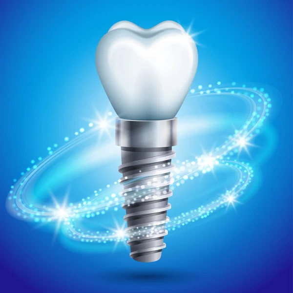 Vector Illustration Dental Implant Icon Stock Illustration