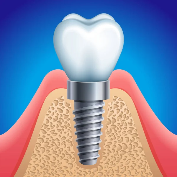 Векторная Иллюстрация Иконка Зубного Импланта Векторная Графика