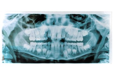 x ışını üzerinde beyaz izole jaws