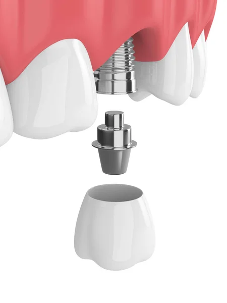 歯と白い背景上歯科臼歯インプラント上顎の レンダリング — ストック写真