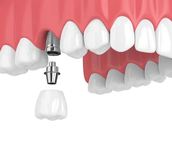 在白色背景下用牙和牙磨牙种植体上颌骨的渲染 — 图库照片