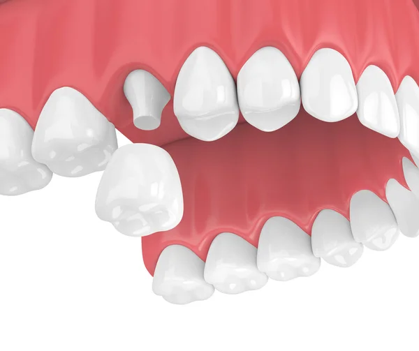 Візуалізація Верхньої Щелепи Зубами Реставрацією Зубної Корони Білому Тлі — стокове фото