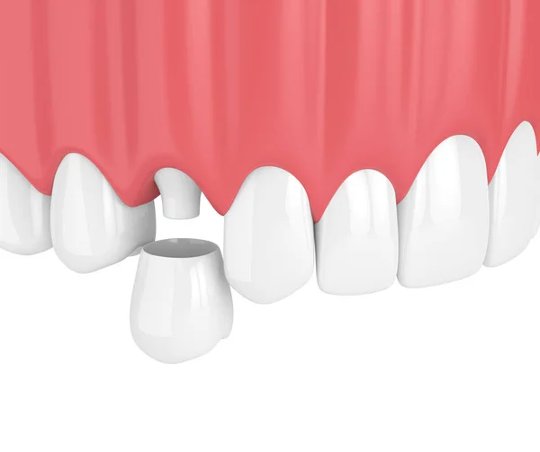 Renderizado Mandíbula Superior Con Dientes Corona Premolar Dental Sobre Fondo — Foto de Stock
