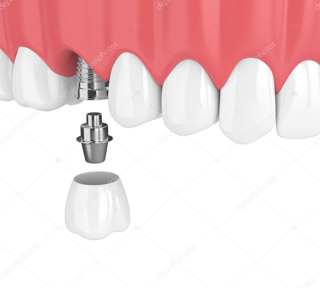 3d render of upper jaw with teeth and dental molar implant over white background
