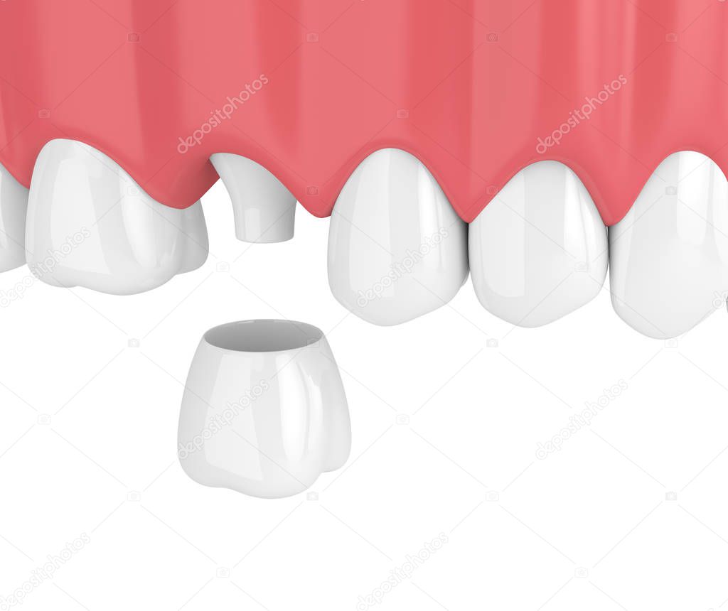 3d render of upper jaw with teeth and dental crown restoration over white background