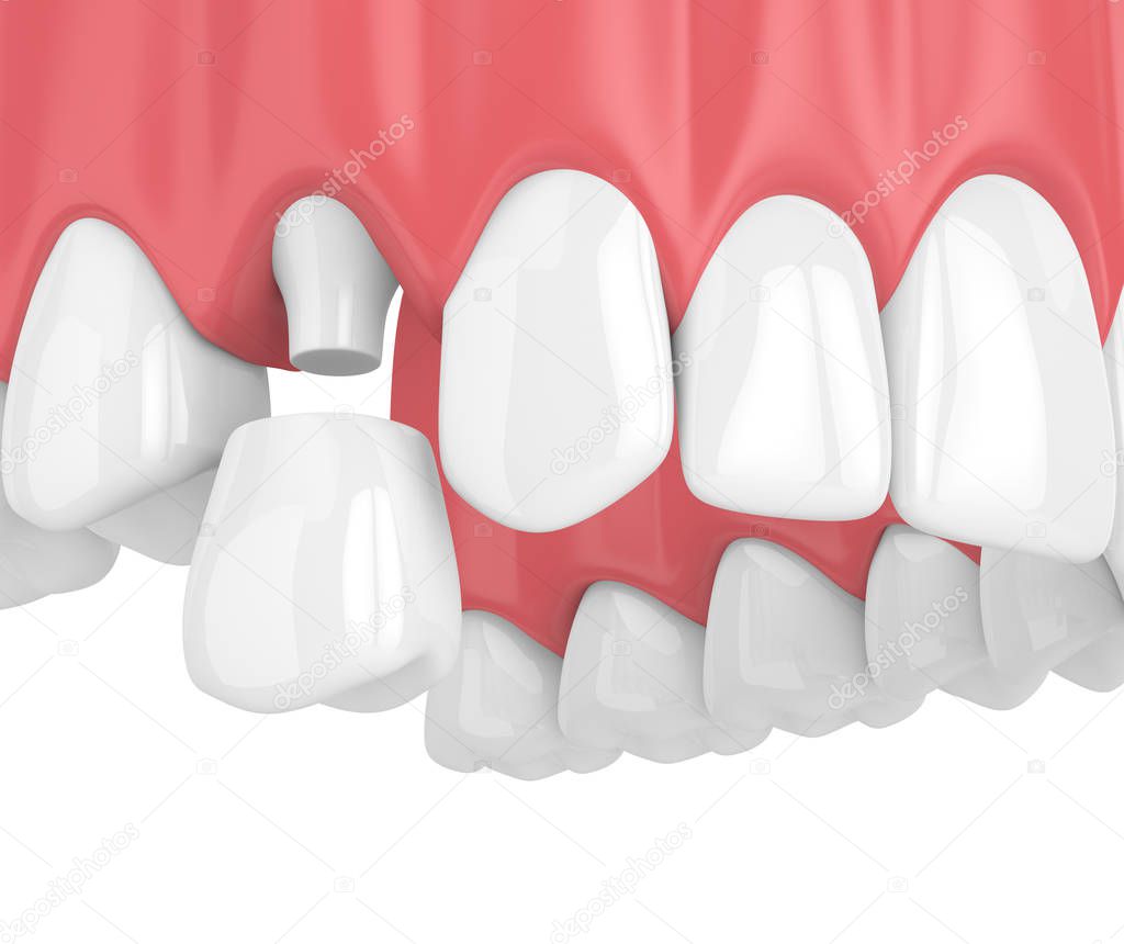 3d render of upper jaw with teeth and dental premolar crown over white background