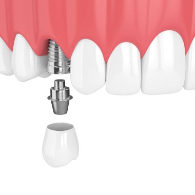 diş ve diş azıdişinde implant beyaz arka plan üzerinde üst çene 3D render