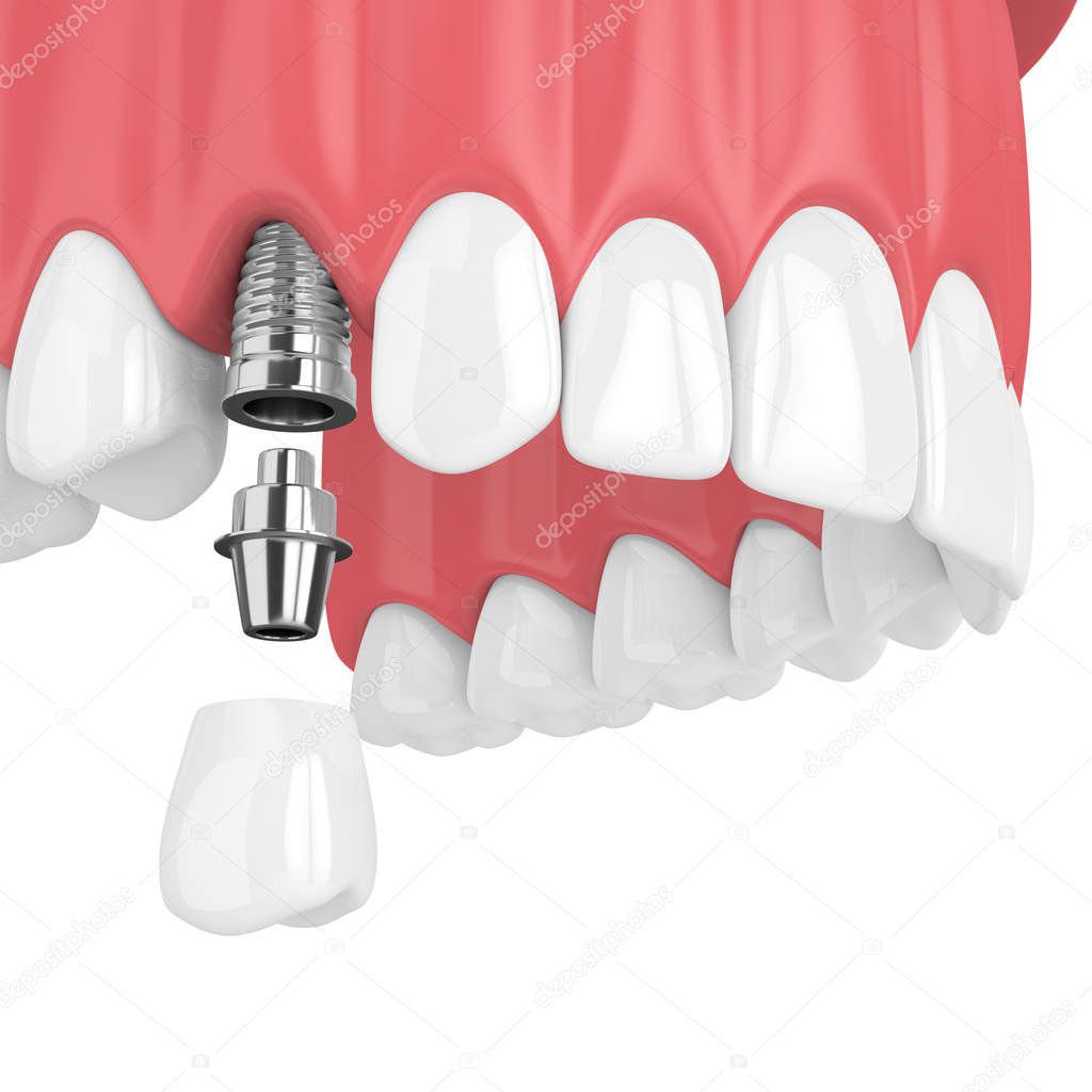 3d render of upper jaw with teeth and dental premolar implant over white background