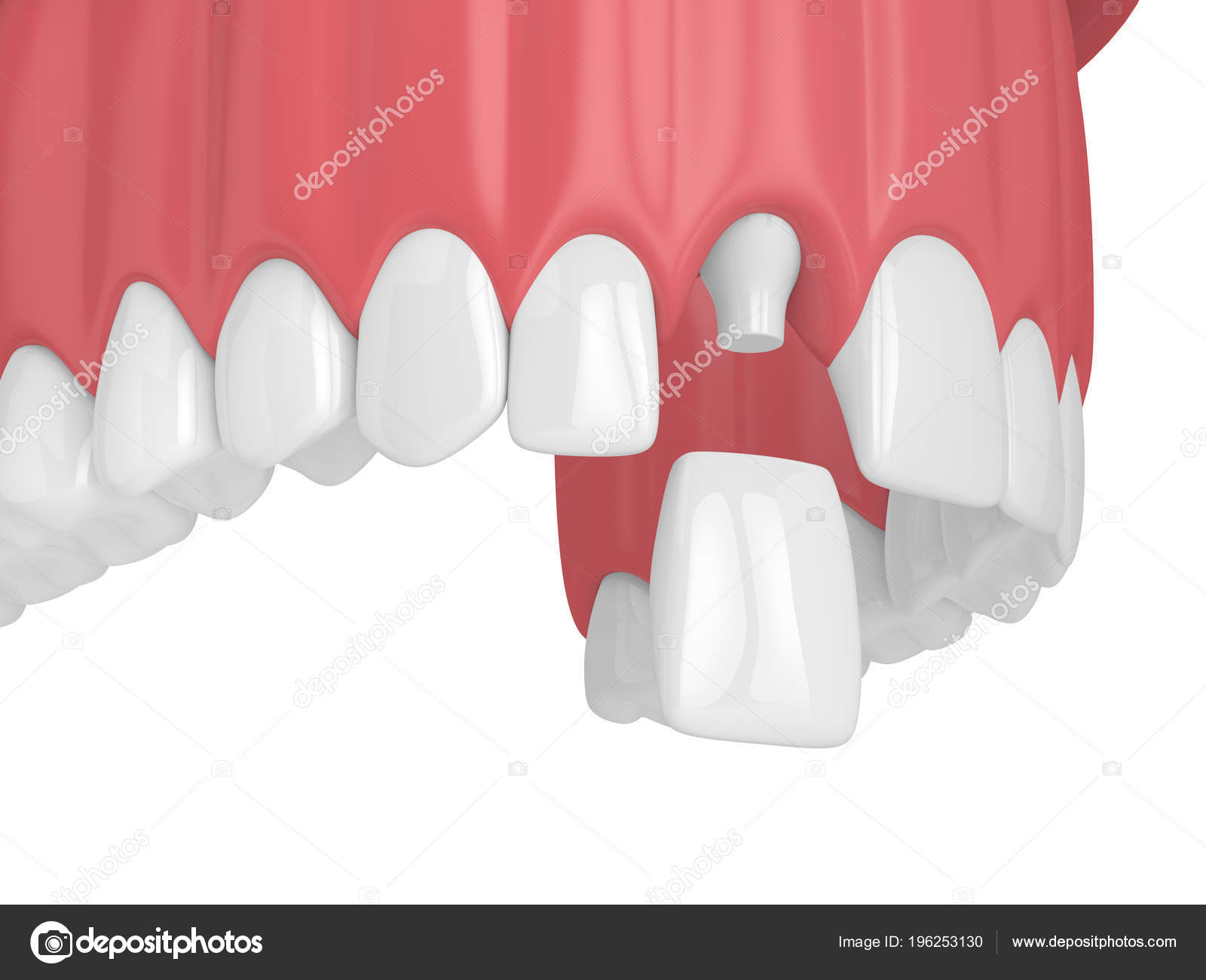 incisivo dental incisivo lateral incisivo dental incisivo lateral