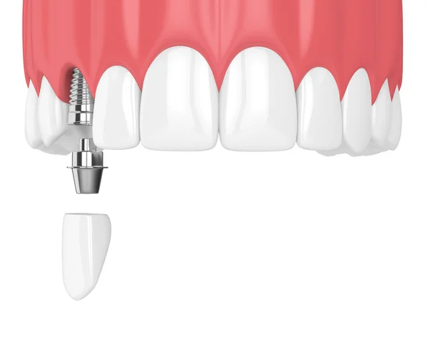Üst Çene Dişleri Beyaz Arka Plan Üzerinde Köpek Diş Implant — Stok fotoğraf