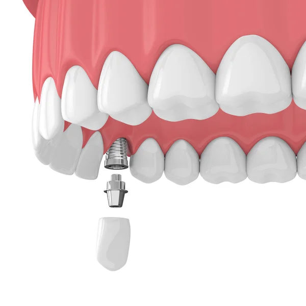 Render Upper Jaw Teeth Dental Lateral Incisor Crown White Background