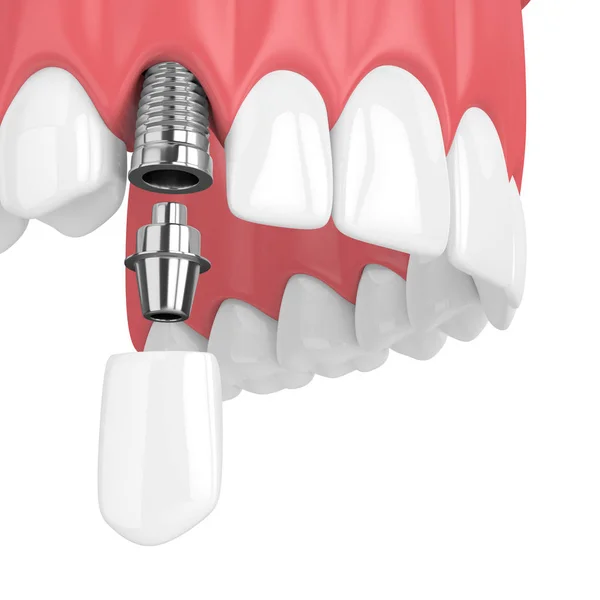 上顎の歯と白い背景の上犬歯科のインプラントの レンダリング — ストック写真