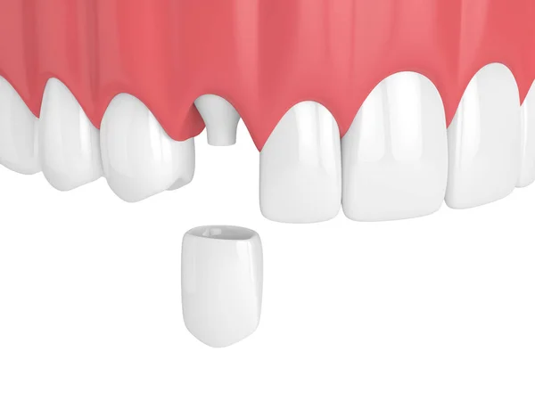 Render Upper Jaw Teeth Dental Canine Crown White Background — Stock Photo, Image