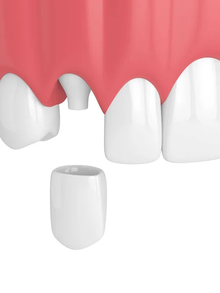 Render Upper Jaw Teeth Dental Canine Crown White Background — Stock Photo, Image