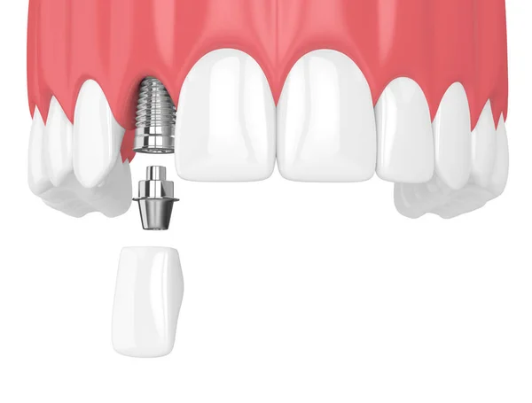 Renderização Mandíbula Superior Com Dentes Implante Incisivo Lateral Dental Sobre — Fotografia de Stock
