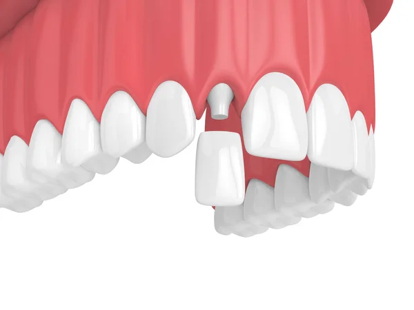 在白色背景下 用牙齿和牙齿侧切牙冠上颌骨渲染 — 图库照片