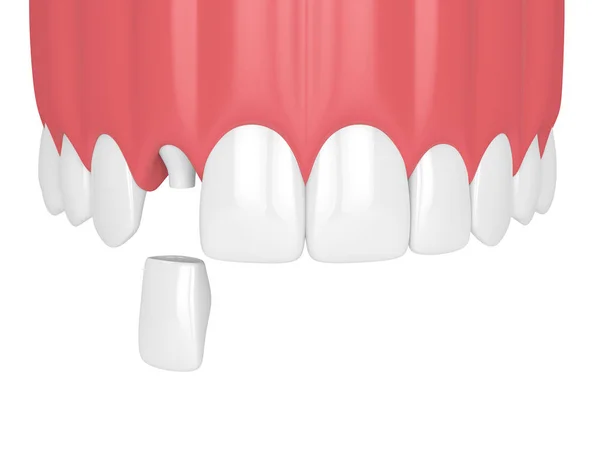 Renderizado Mandíbula Superior Con Dientes Corona Incisiva Lateral Dental Sobre — Foto de Stock