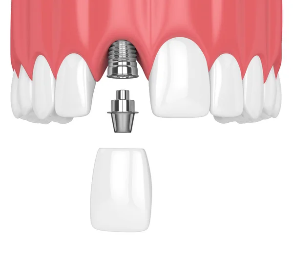 Činí Horní Čelisti Zuby Zubní Řezák Implantát Nad Bílým Pozadím — Stock fotografie
