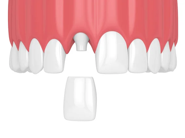 Рендеринг Верхней Челюсти Зубами Зубной Коронки Резца Белом Фоне — стоковое фото
