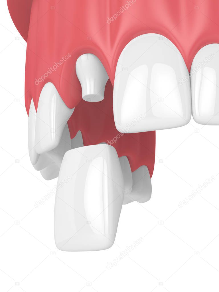 3d render of upper jaw with teeth and dental incisor crown over white background
