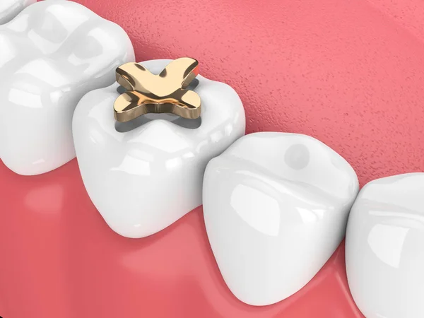 3d render of teeth with dental inlay golden filling over white background