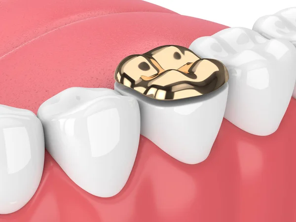 Renderizado Dientes Con Relleno Onlay Dorado Dental Encías Sobre Fondo —  Fotos de Stock