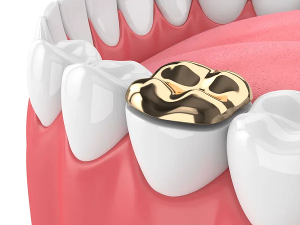 Render Teeth Dental Golden Onlay Filling Gums White Background — Stock Photo, Image