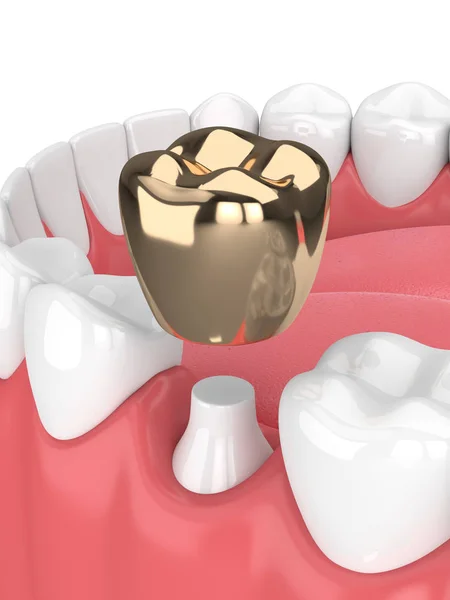 Render Teeth Dental Golden Crown Filling Gums White Background — Stock Photo, Image