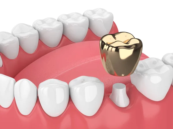 Darstellung Des Kiefers Mit Goldener Zahnkrone Zahnfleisch Vor Weißem Hintergrund — Stockfoto