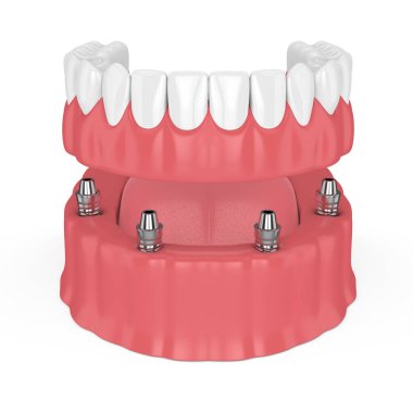 çıkarılabilir tam 3D render beyaz arka plan üzerinde izole takma diş implant