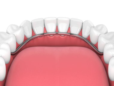 Beyaz arka plan üzerinde izole çıkarılabilir kısmi takma diş 3D render