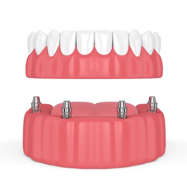 çıkarılabilir tam 3D render beyaz arka plan üzerinde izole takma diş implant