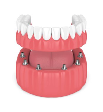 çıkarılabilir tam 3D render beyaz arka plan üzerinde izole takma diş implant
