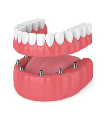 çıkarılabilir tam 3D render beyaz arka plan üzerinde izole takma diş implant