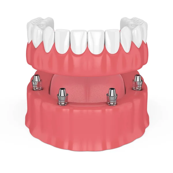 Render Removable Full Implant Denture Isolated White Background — Stock Photo, Image